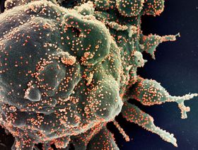 صورة مجهرية إلكترونية ملونة لوت الخلايا المبرمج (خضراء) مصابة بشدة بجزيئات فيروس سارس-كوفيد-2 (برتقالية) ،من عينة مريض. - المصدر: بلومبرغ