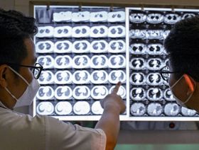 أطباء يتحققون من الأشعة السينية لمريض سلّ في هانوي. والسلّ واحد من 13 مرضاً على الأقل ارتفعت معدلات الإصابة به مقارنة بحقبة ما قبل الوباء في بعض المناطق في العالم - المصدر: أ.ف.ب