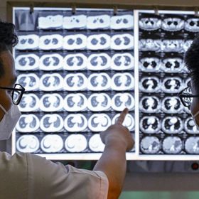 أطباء يتحققون من الأشعة السينية لمريض سلّ في هانوي. والسلّ واحد من 13 مرضاً على الأقل ارتفعت معدلات الإصابة به مقارنة بحقبة ما قبل الوباء في بعض المناطق في العالم - المصدر: أ.ف.ب
